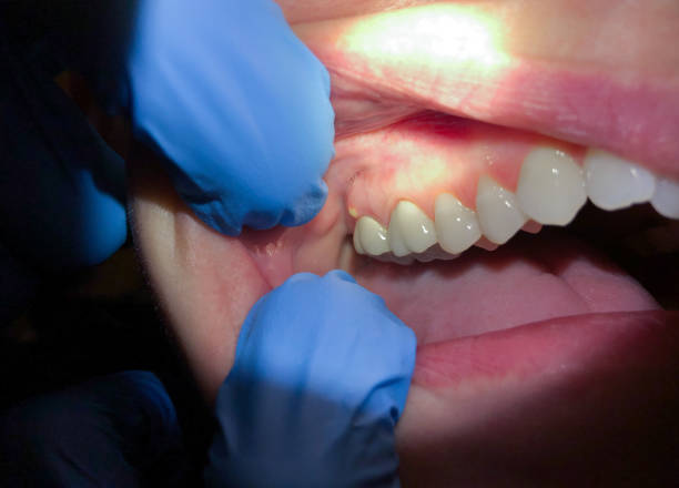 Best Emergency Wisdom Teeth Removal in Fort Polk North, LA