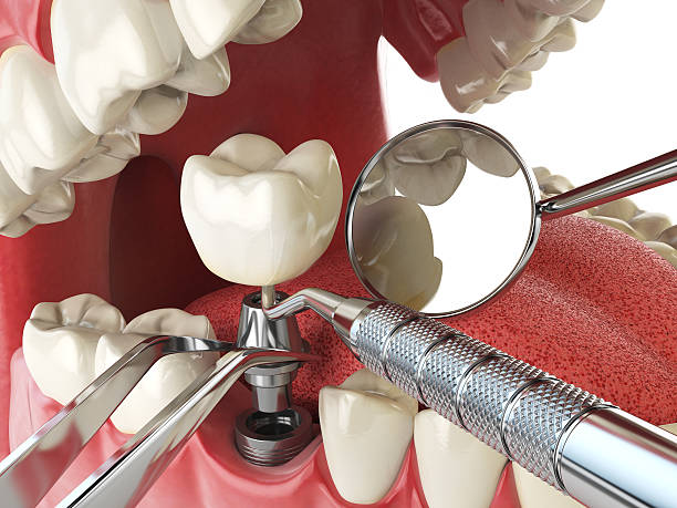 Best Emergency Root Canal Treatment in Fort Polk North, LA