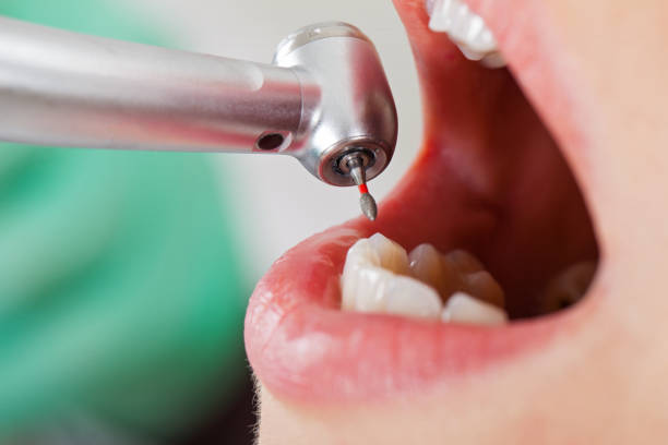 Best Emergency Tooth Extraction in Fort Polk North, LA